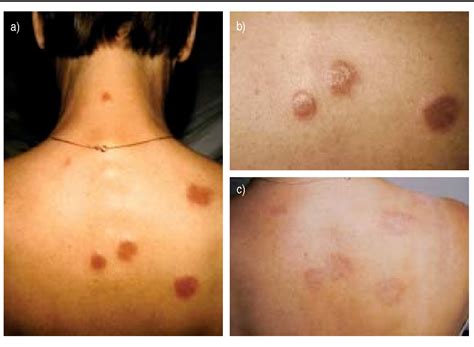 Pdf Skin Manifestations In Sarcoidosis Semantic Scholar