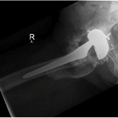 Pdf A Case Of Titanium Pseudotumor And Systemic Toxicity After Total