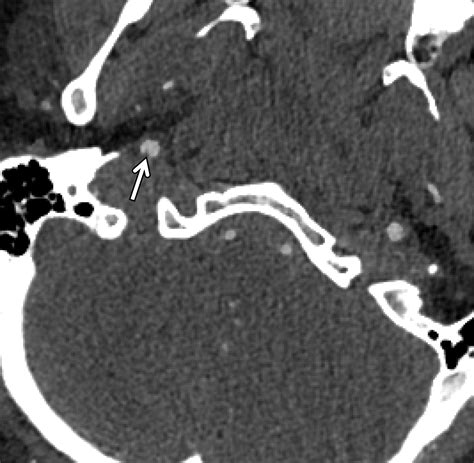 Imaging And Management Of Blunt Cerebrovascular Injury Radiographics