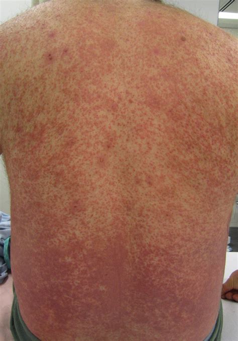 Allergic Vasculitis Rash