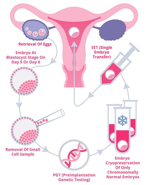 Ivf Success With Single Embryo Transfer And Pgt Irms