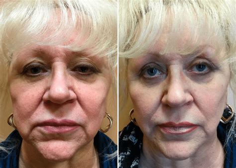Juvederm Ultra Before And After Photos New Jersey Reflections Center