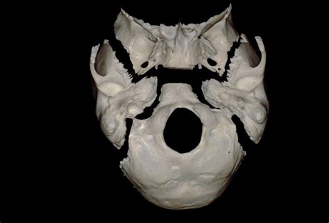 Inferior View Of Disarticulated Sphenoid Temporal And Occipital Bones