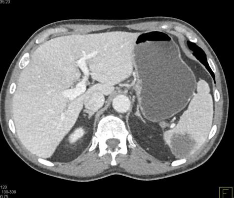 Multiple Splenic Infarcts Spleen Case Studies Ctisus Ct Scanning