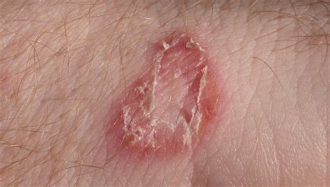 Whats On My Skin 8 Common Bumps Lumps And Growths Skin Disorders