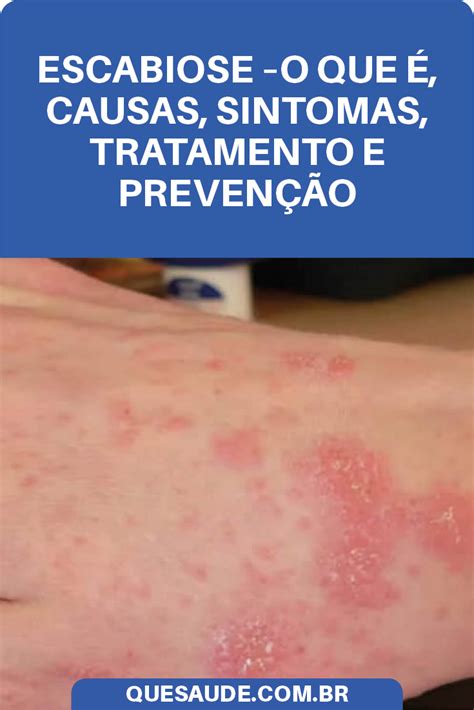 O que provoca a sarna humana? Escabiose - O Que é, Causas, Sintomas, Tratamento e ...