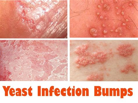 This Could Probably Be Yeast Infection Bumps Caused By Candida Albicans Which Yeast Infection