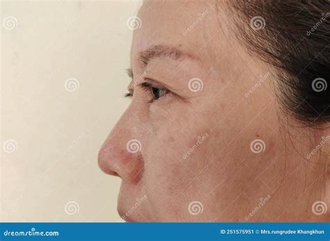The Flabby Sagging And Dullness On The Face Stock Image Image Of