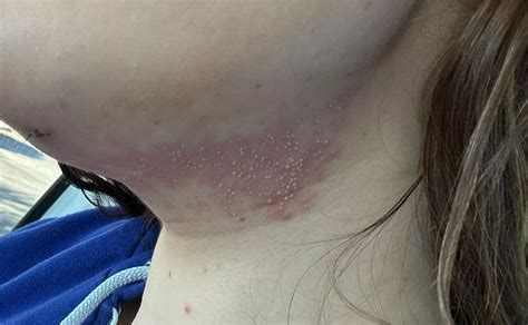 Forbidden Pops Folliculitis After Chin Lipo Nudes Popping NUDE