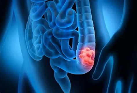 Bowel Cancer Ignoring These 12 Symptoms Of Bowel Cancer Can Be Fatal