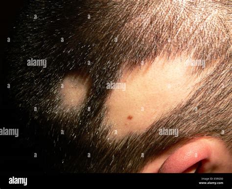 Bald Spot On The Scalp Of A Child Due To Alopecia Areata Stock Photo
