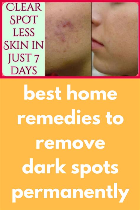 Best Dark Spot Remover For Face Home Remedies Home Rulend