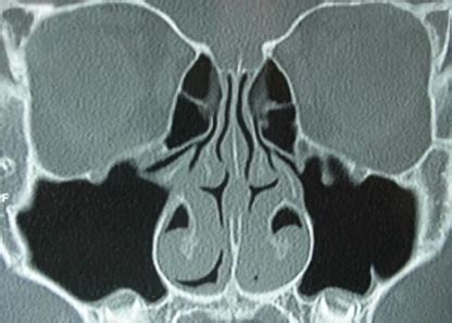 Some septal deformities, however, may cause. Insurance Cover: Insurance Cover Deviated Septum
