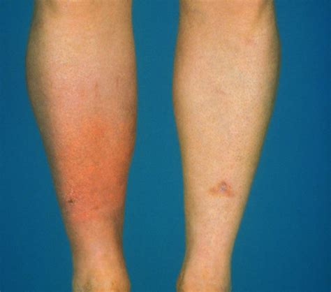 Prophylactic Antibiotics May Be Best Bet For Preventing Cellulitis