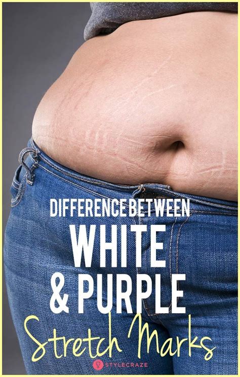 Do You The Know The Difference Between White Stretch Marks And Purple