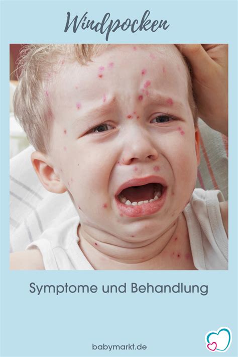 Die ursache von windpocken ist das ansteckend sind erkrankte allerdings schon ein bis zwei tage bevor der ausschlag beginnt. Windpocken | Windpocken, Baby wallpaper, Kinderkrankheiten