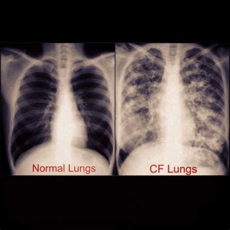 Normal Lungs Vs Cf Lungs