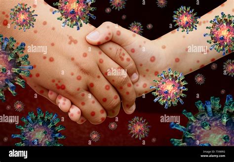 Viral Diseases And Measles Disease And Or Virus Illness As A Contagious