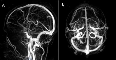 Cerebral Angiography With Normal Aspect In Both Internal And External Download Scientific