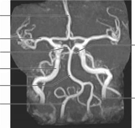 Label the blood vessels of the male pelvis using the hints provided. Mr angiogram mra - Spinal Cord - RR School Of Nursing