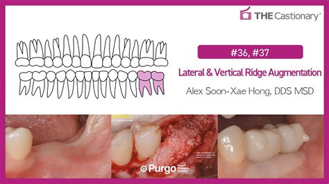 36 37 Lateral And Vertical Ridge Augmentation Youtube