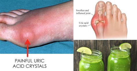 How to prevent gout attacks lifestyle factors may reduce the risk of having gout attacks. How To Quickly Remove Uric Acid Crystalization From Your ...