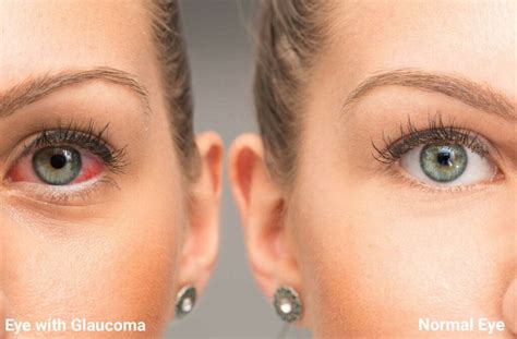 What Does Glaucoma Look Like Carolina Eyecare Physicians