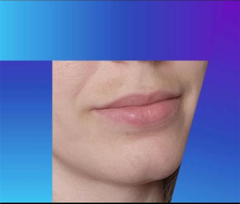 What Can Help Lighten Upper Lip Discoloration Rskincareaddicts