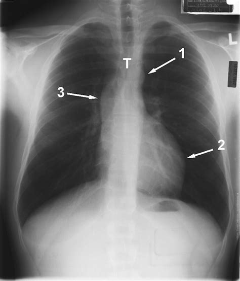 Thoracic Aortic Aneurysm Chest X Ray