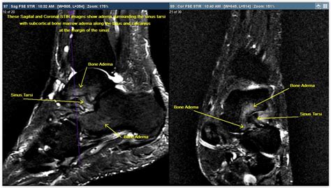 Exposure to dangerous ionizing radiation. MRI Foot Case Study | Greater Waterbury Imaging Center