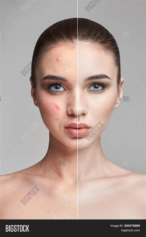 Pimples Acne On Woman Image And Photo Free Trial Bigstock