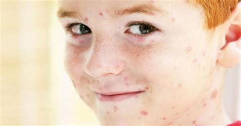 La varicella e il morbillo - sono uno e la stessa malattia ...