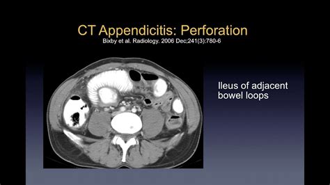 Imaging Of Appendicitis Youtube