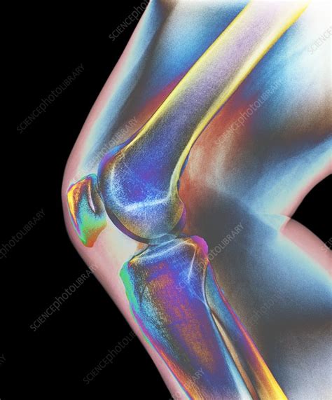 Normal Knee X Ray Stock Image F0033609 Science Photo Library