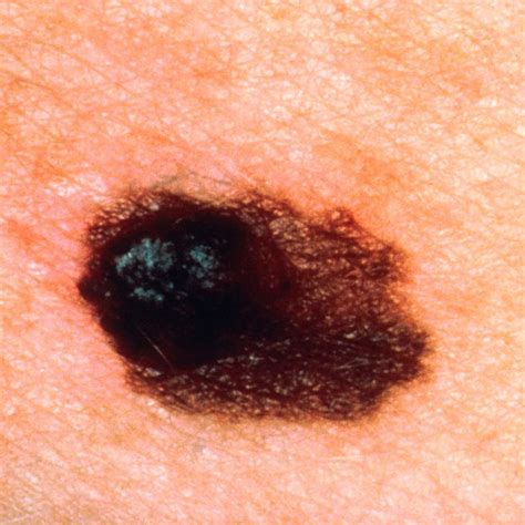 Skin Cancer Symptoms Signs Types Treatments And Prevention