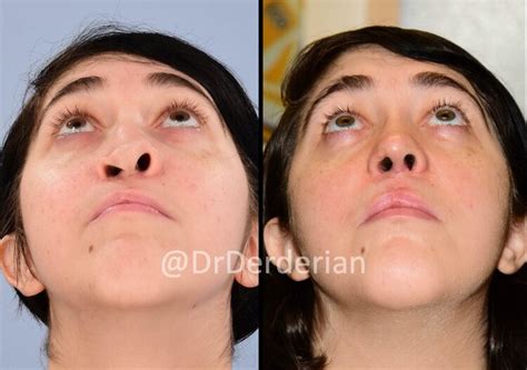 Adult Cleft Rhinoplasty Dr Derderian Plastic And Reconstructive Surgery
