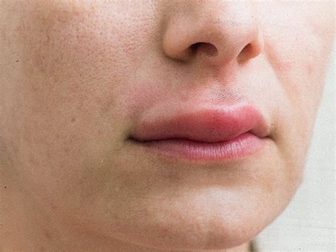 Swollen Upper Lip Causes And Treatments