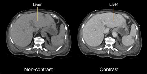 Abdominal CT Basics LITFL Radiology Library