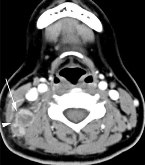 Kikuchi Disease Differentiation From Tuberculous Lymphadenitis Based