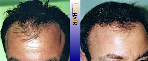 Gallery Hair Loss Recovery By Dr Larry Fremont