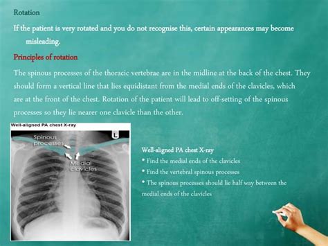 Chest X Ray Quality How To Interpret Chest X Ray 1 Ppt