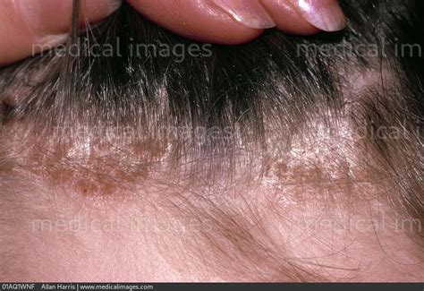 Stock Image Dermatology Scalp Psoriasis Improving Dry White Plaque