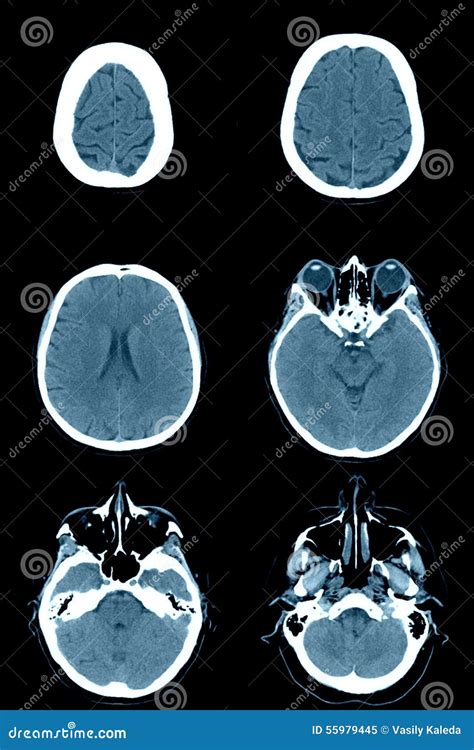 Normal Head On Ct Scans Royalty Free Stock Photography Cartoondealer