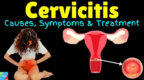 Cervicitis Symptoms Causes Diagnosis Treatment Complications Prognosis Youtube
