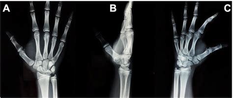 Preoperative Plain Radiographs Anteroposterior A Lateral B And
