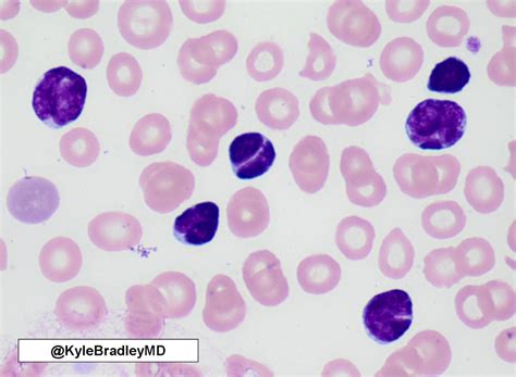 B Cell Lymphoma Blood Film Pathology Outlines Follicular Usual