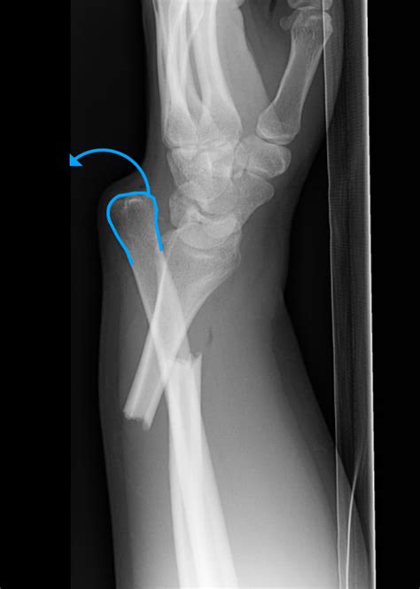 Galeazzi Fracture Dislocations