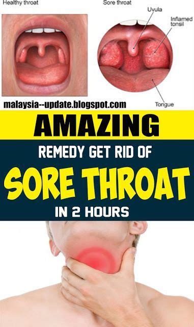 Magnificent Remedy To Get Rid Of Sore Throat In 2 Hours Remedies