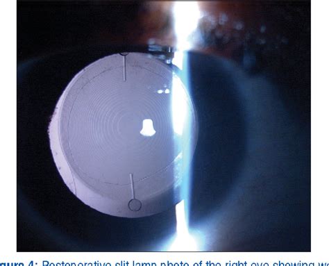 Figure 1 From Toric Multifocal Intraocular Lens Implantation In A Case