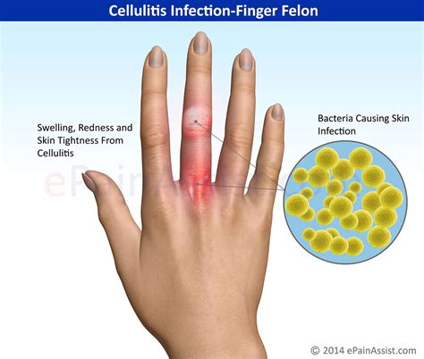 Cellulitis Infection Finger Feloncausessymptomstreatment Antibiotics